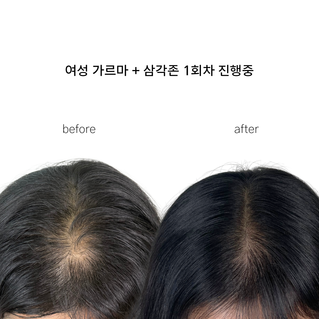 날짜무관/ 양주옥정 (의정부, 포천, 동두천,남양주) 두피문신 모델 구합니다 :)