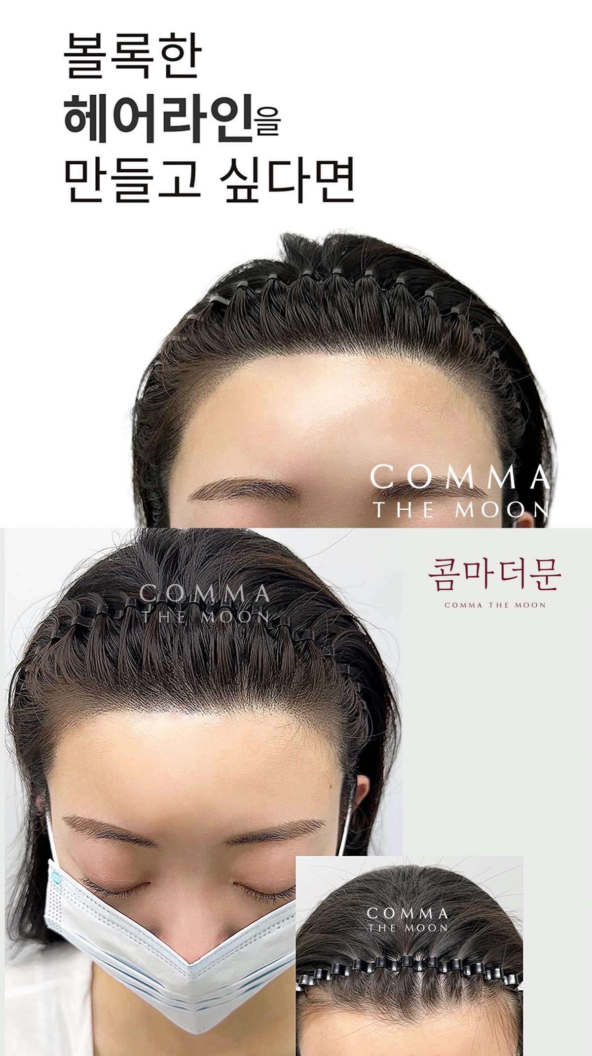 ★SMP두피문신 전액무료★남,여 무관 (헤어라인 M자이마) 모집합니다  ​