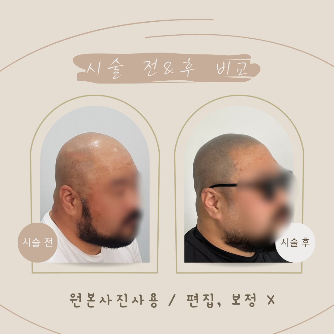 창원 두피문신 무료모델 구인(전액무료)