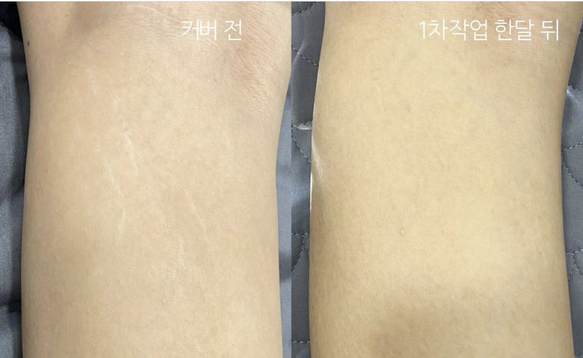 튼살커버 모델 모집합니다