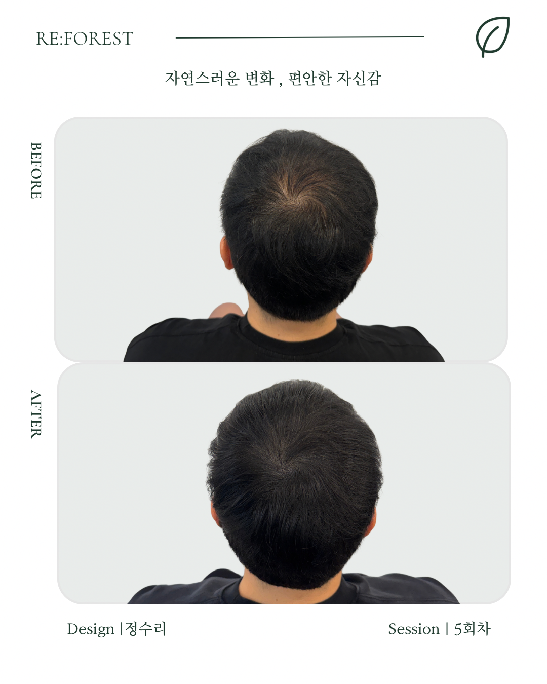 대구 두피문신 포토폴리오 모델 특별가 안내