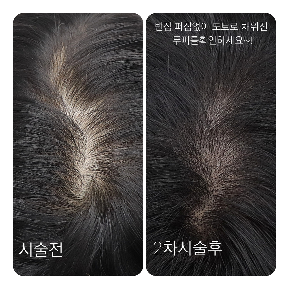 두피문신 모델구합니다