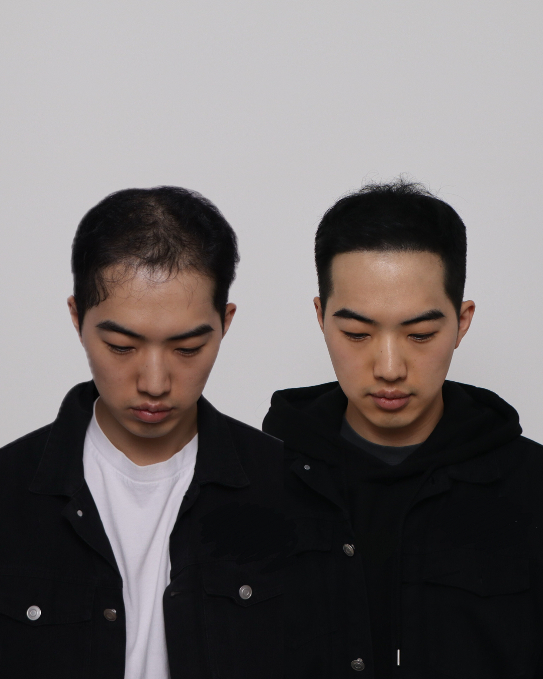두피문신 모델 구합니다.