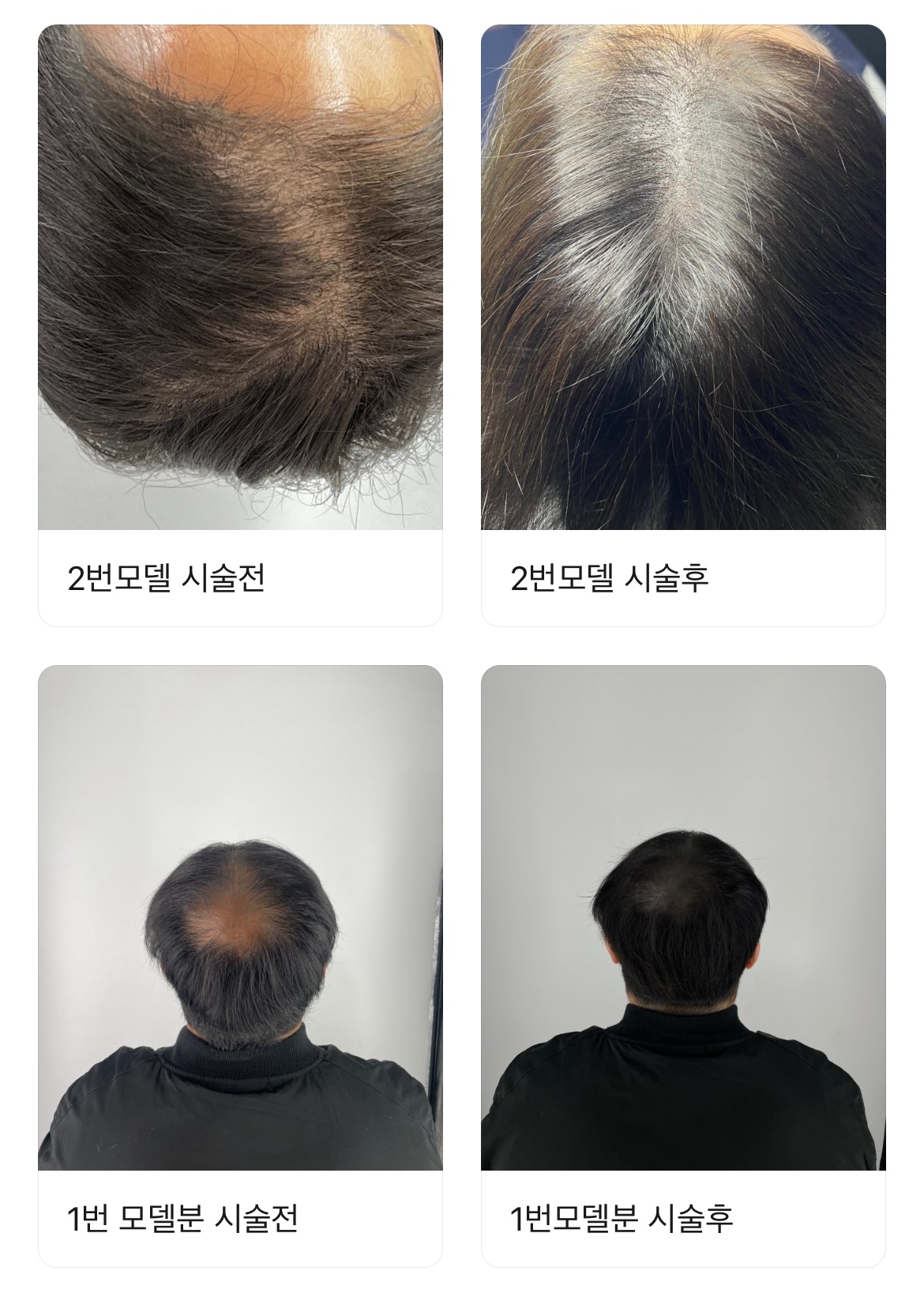 두피문신 모델구인합니다~