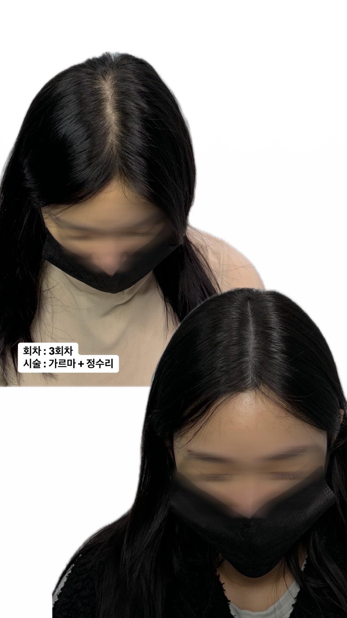 강남역도보3분 두피문신 모델 모집