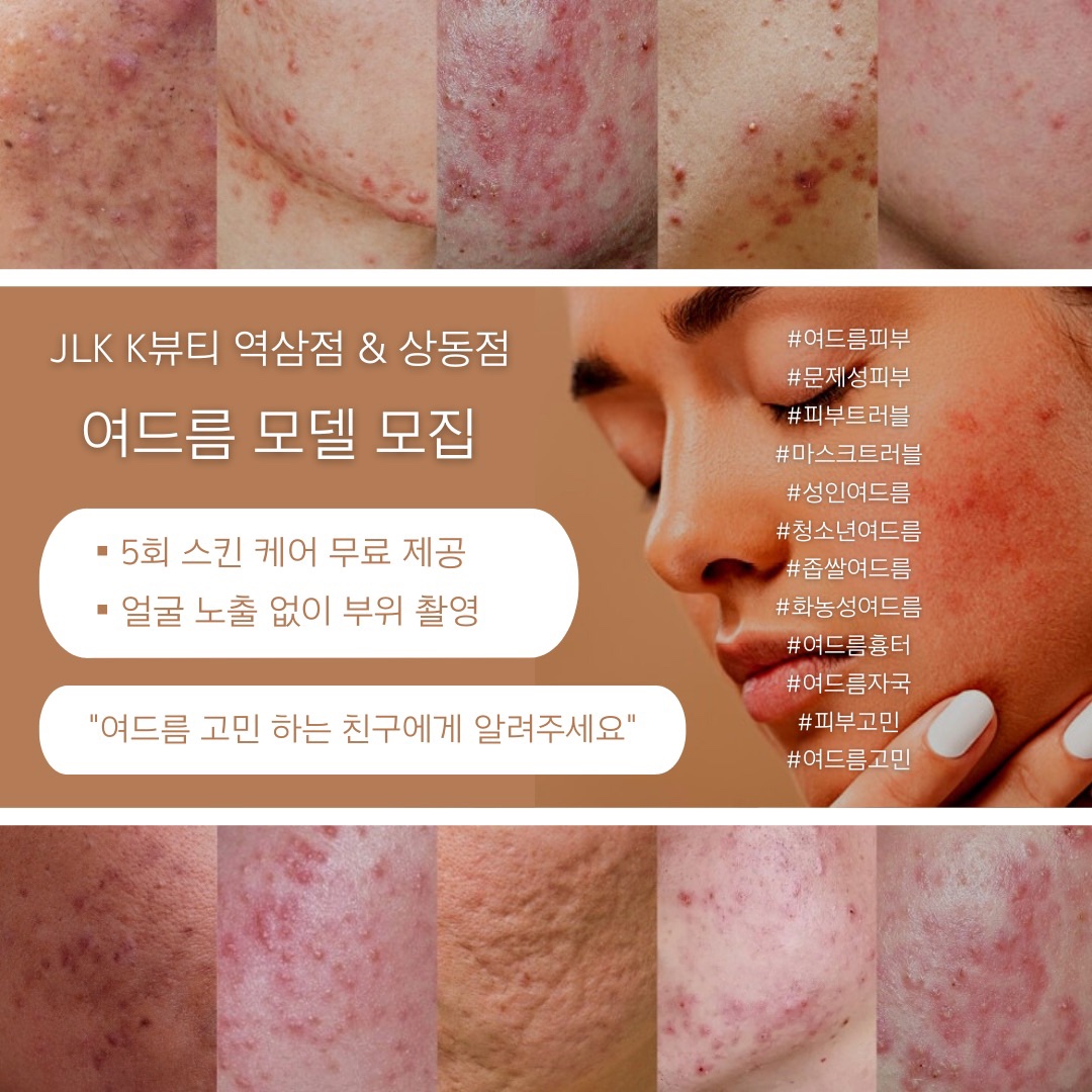 여드름 피부로 고민하시는 분들 연락주세요