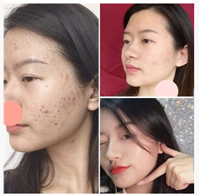 여드름화장품 피부모델 구합니다