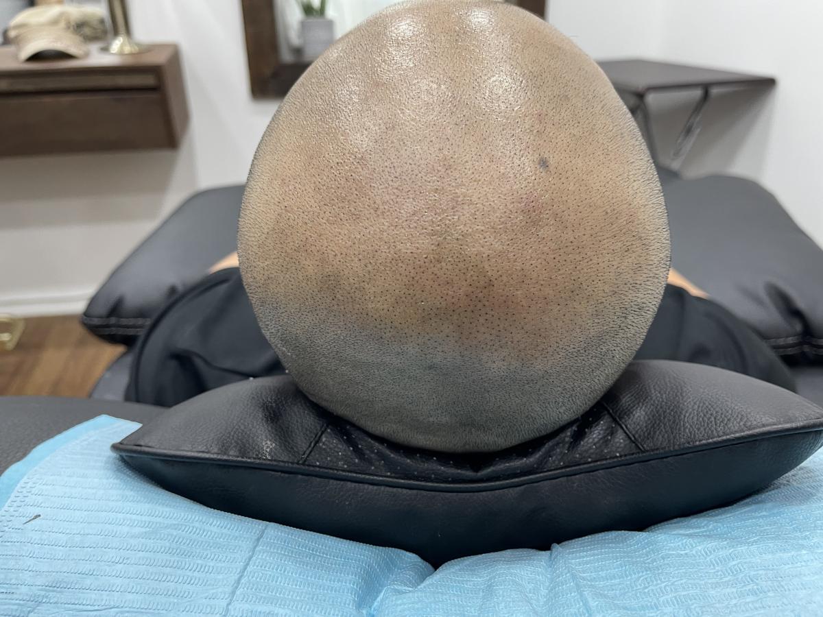 두피문신 smp 모델 구합니다