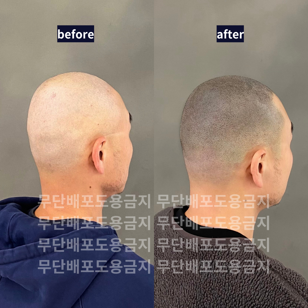 삭발 smp 두피문신 포트폴리오용 모델 구합니다!
