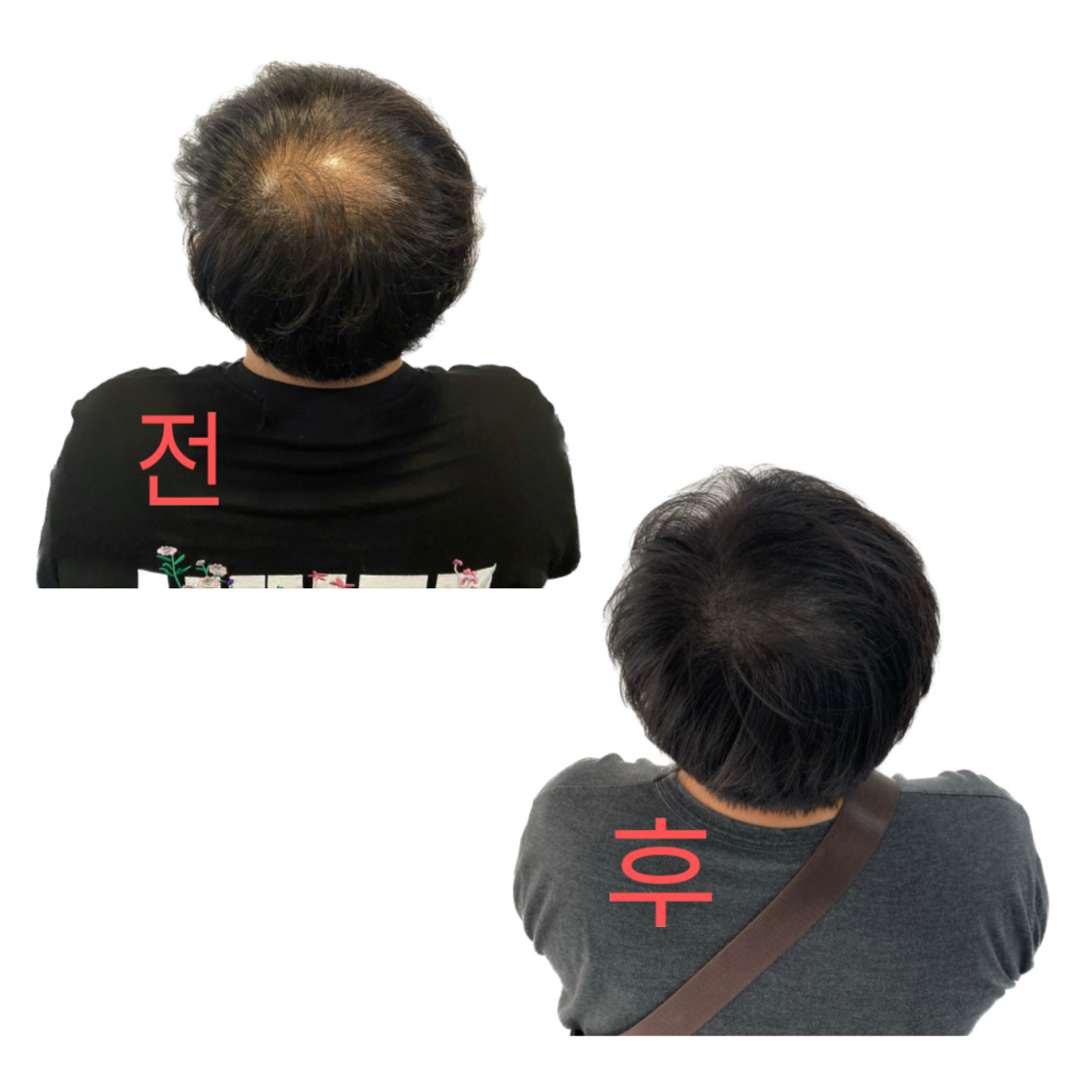두피문신 모델 급히구해요