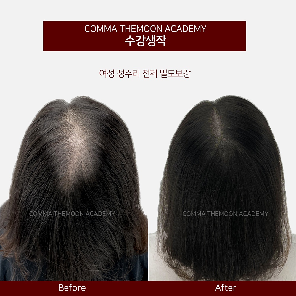 ★국내최다데이터보장★ ★SMP두피문신 전액무료★남,여 무관 (정수리 가르마 헤어라인 M자이마 ) 모집합니다★